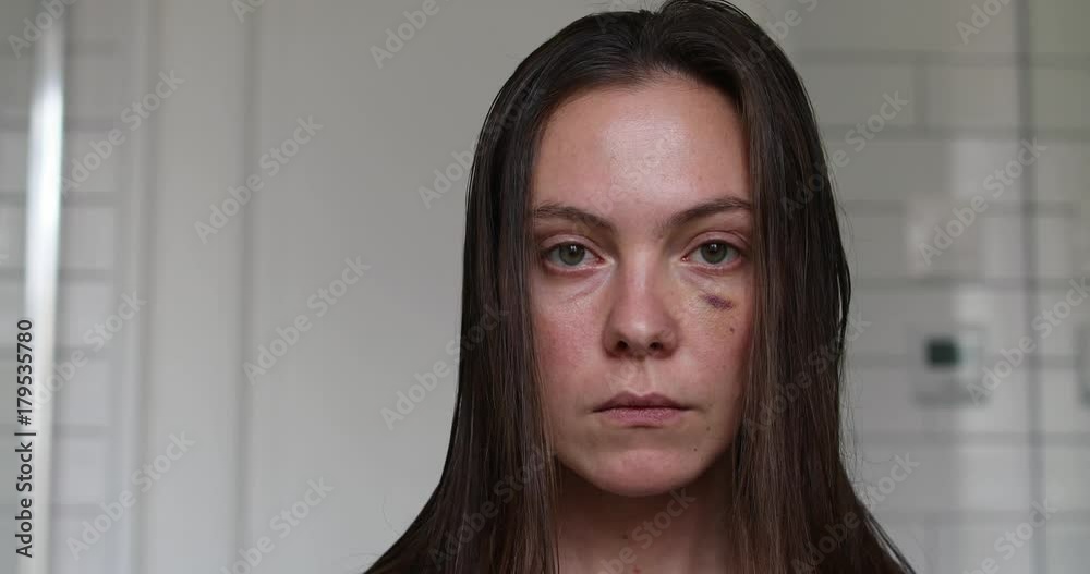 Woman with black eye closeup portrait. Injured woman with bruised eye