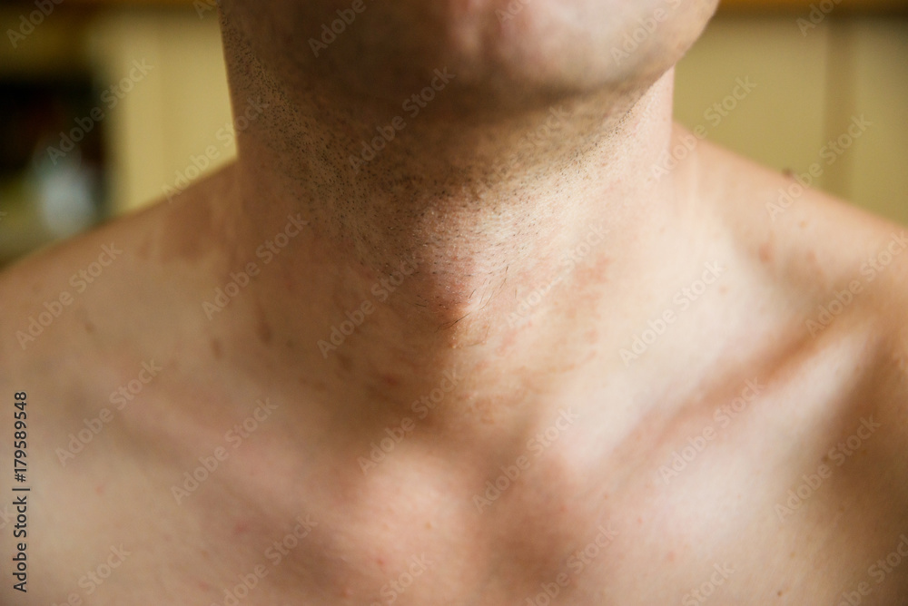 Fototapeta premium dermatitis skin