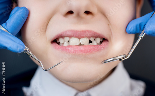 Kid showing teeth at dental check up. Close-up of dentist's hand with dental tools - probe and mirror in dental office. Dentistry
