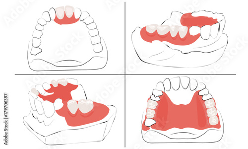 four variants of partial denture