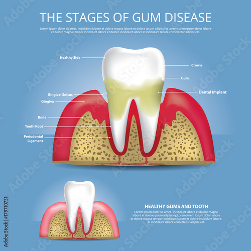 Human teeth Stages of Gum Disease Vector Illustration