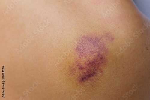 Foto bruised and injured from domestic violence on female from  retirement home or ca