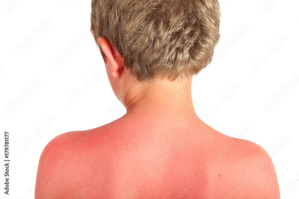 Naklejka premium Sunburn on a child's back