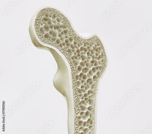 Osteoporosis stage 1 of 4 -- 3d rendering photo