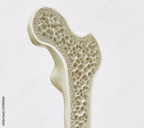 Fototapeta Naklejka Na Ścianę i Meble -  Osteoporosis stage 1 of 4 -- 3d rendering