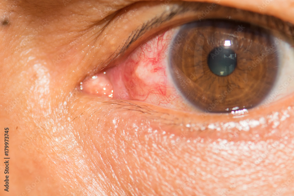 Conjunctivitis Conjunctivitis