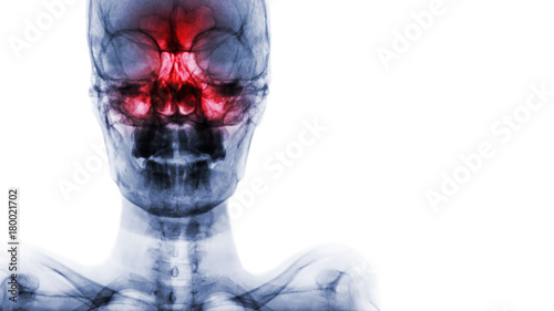Sinusitis at frontal , ethmoid , maxillary sinus . Film x-ray of skull and blank area at right side