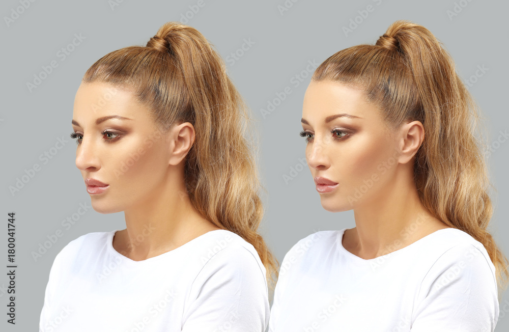Rhinoplasty. Rhinoplasty.