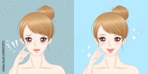 woman with eye bags surgery