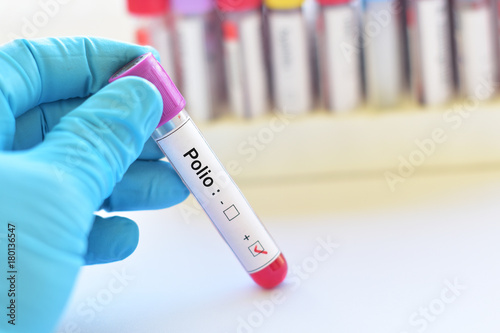Blood sample positive with polio virus photo