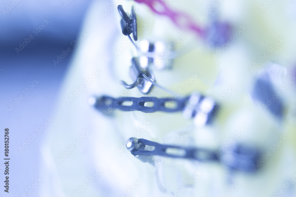 Dental teeth brackets aligners Dental teeth brackets aligners