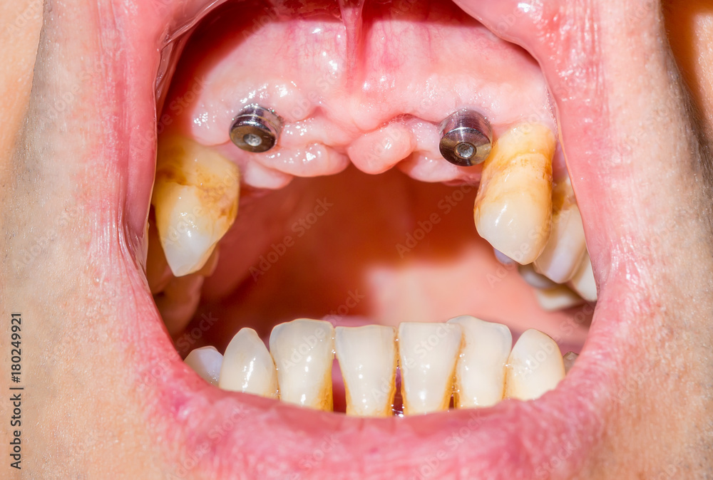 Canine dental implants in the mouth of a patient with advanced periodontitis