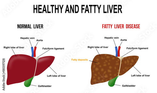 Healthy and fatty liver