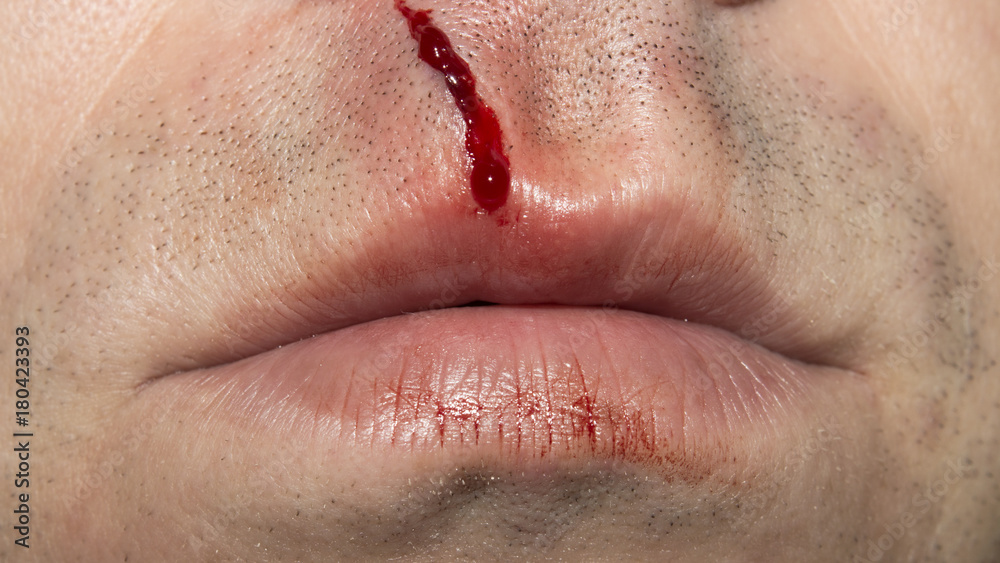 Naklejka premium Dissection of the upper lip.My lip is bloody.The wound of a man's lip.