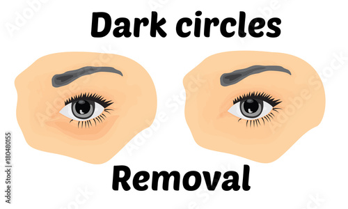 Dark circles under eyes to remove