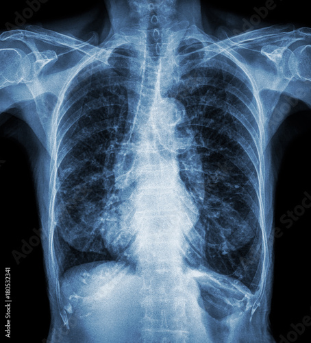 Normal chest X-ray of old patient . You can seen calcification at rib , trachea , bronchus . Front view