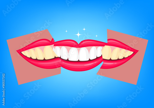 Whitening teeth, before and after. Human mouth, Dental care concept. Illustration isolated on blue background.