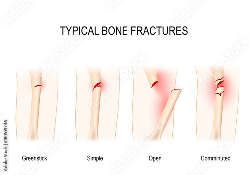 Typical bone fractures.