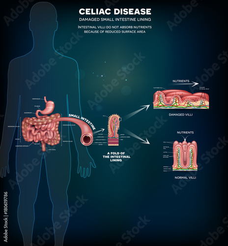 Celiac disease affected small intestine villi. Damaged cells by body's reaction to gluten. Intestinal villi do not absorb nutrients because of reduced surface area. Healthy villi and unhealthy villi.