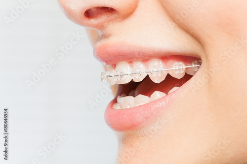 Woman's smile with clear dental braces on teeth photo