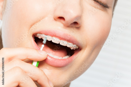 Woman cleaning braces using interdental brush
