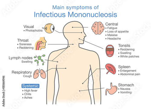 Symptoms of Infectious Mononucleosis disease. Diagram for diagnose patient of doctor.