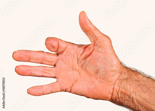 Elderly man hand with amputated finger