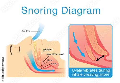Anatomy of human upper airway while sleeping with snoring. Illustration about medical diagram.