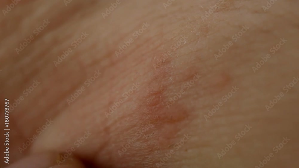 Red spots on the arm. Allergies, psoriasis or insect bite with malaria ...