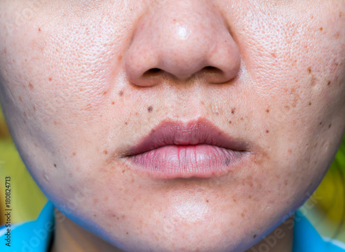 Woman 's problematic skin , acne scars ,oily skin and pore, dark spots and blackhead and whitehead on the face.