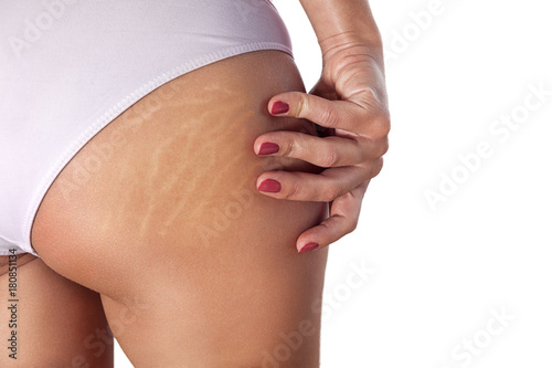 Woman buttocks with stretch marks and cellulite photo