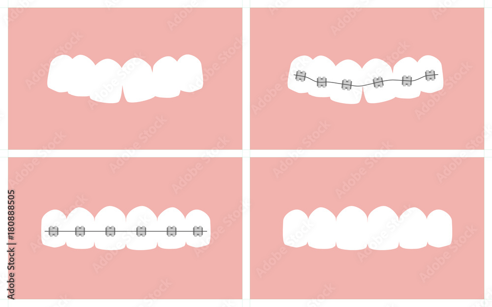 Vector image of the stages of orthodontic treatment (braces on teeth