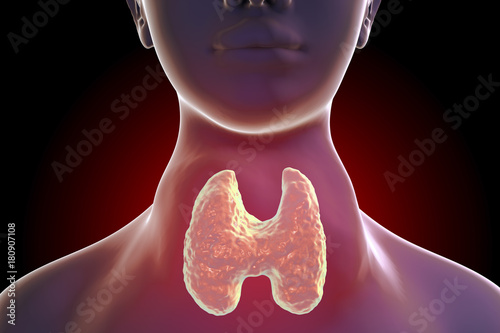 Toxic diffuse goiter, Flajani-Basedow-Graves' disease. 3D illustration showing enlarged thryoid gland in a female with hyperthyroidism photo