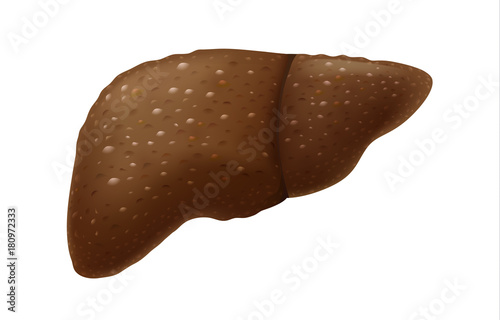 Human liver have scar tissue problem from drink alcohol too much. Illustration about Hepatitis and Cirrhosis symptom.