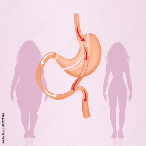 gastric bypass surgery