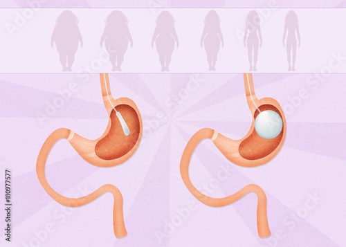 Canvastavla intragastric balloon