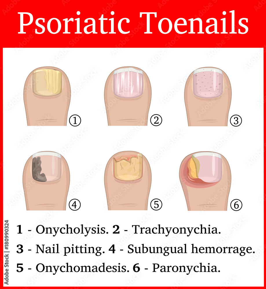 Types Of Nail Psoriasis Nail Pitting Psoriasis Fingernail Vector, Nail  Pitting, Psoriasis, Fingernail PNG and Vector with Transparent Background  for Free Download