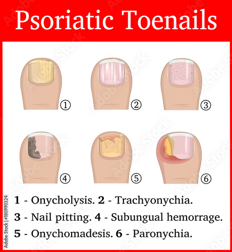 Illustration of Psoriatic toenails