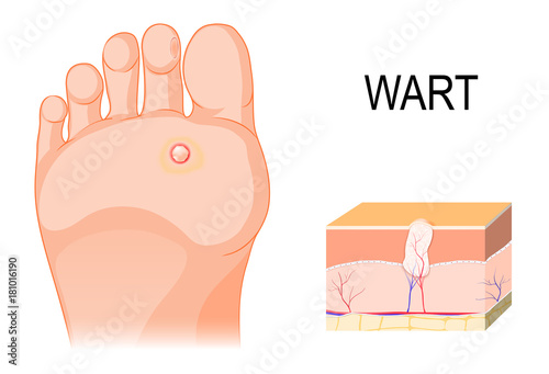 Foot warts on the bottom of soles and toes. Cross section of a common wart