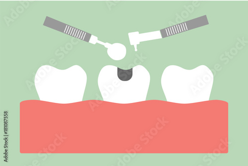 tooth amalgam filling with dental tools