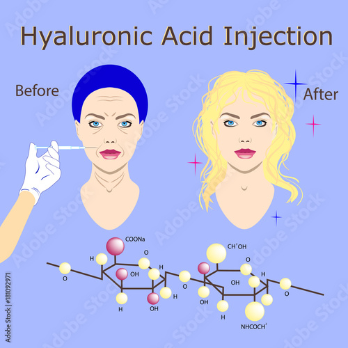 hyaluronic acid injection, before and affect , vector illustration