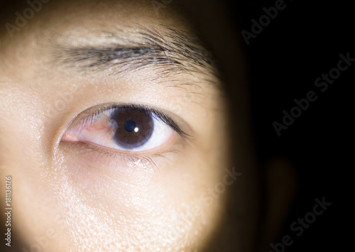 A man have pterygium is in the eye. Close up view and light from the lamp. photo