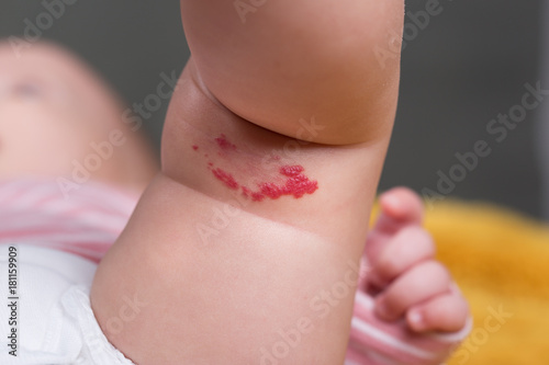 Фотография Capillary hemangioma red birthmark on the babys leg