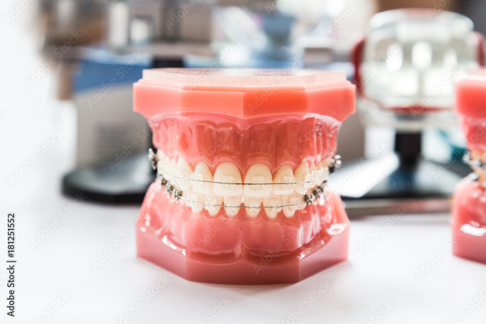Orthodontics dental braces on teeth model to align teeth Stock Photo ...