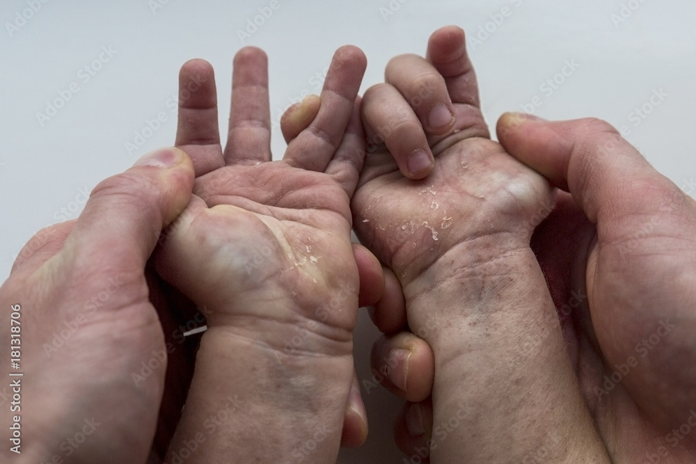 Scarlet fever. Two children's hands with rash on white background. Scarlet fever. Two children's hands with rash on white background.