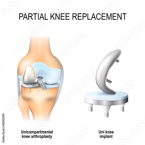 partial knee replacement. photo