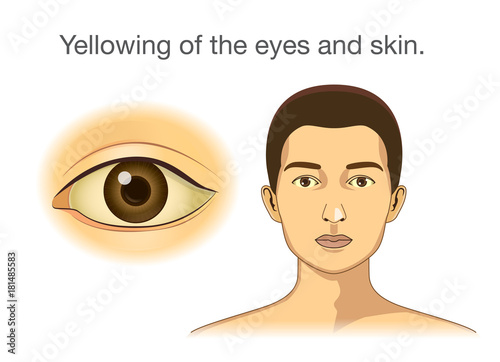 Yellowing of the eyes and skin. Illustration about abnormal symptom of human body from health problems.