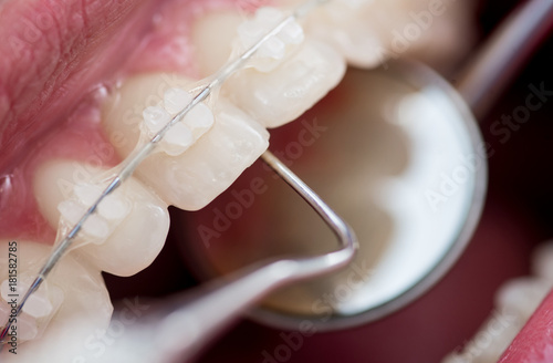 Dentist checking up teeth with ceramic brackets using dental tools - probe and mirror at the dental office. Macro shot of teeth with braces. Orthodontic Treatment. Dentistry