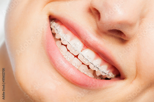 Happy smile of young woman with dental braces photo