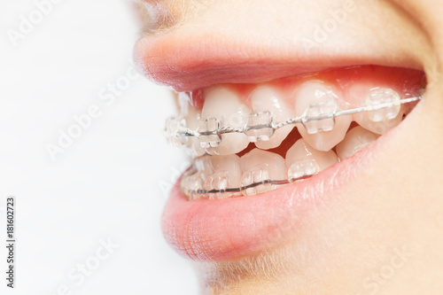 Side view picture of teeth with clear braces